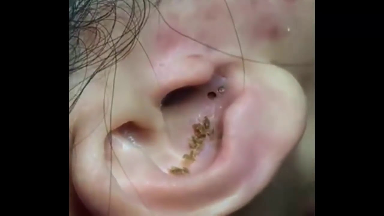 Set of blackheads in the ear / Conjunto de cravos na orelha - YouTube