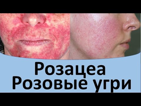 Розацеа. Розовые угри.