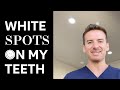 Ask Dr. Shaun: What are these white spots on my teeth?