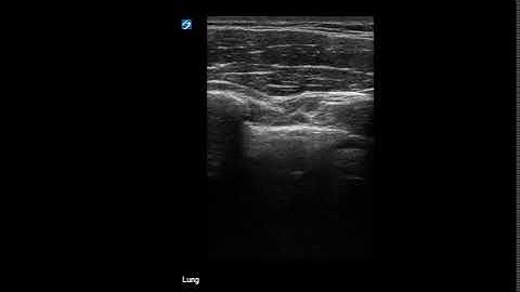 Normal Lung Sliding, M Mode Ultrasound.  JETem 2018