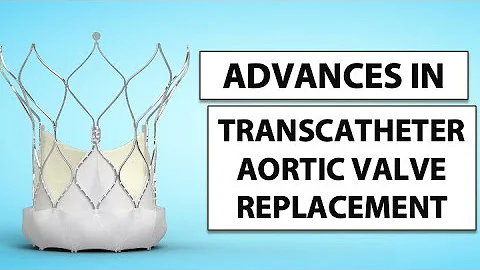 Patient Webinar: Advances in Transcatheter Aortic Valve Replacement (TAVR) - DayDayNews