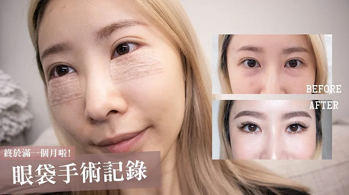 终于满一个月啦！眼袋手术后全记录🙈｜Lower Eyelid Surgery Before & After. - 天天要闻