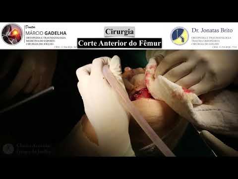 Vídeo: Relação Volume-resultado Hospitalar Na Artroplastia Total Do Joelho: Protocolo Para Revisão Sistemática E Metanálise Não Linear De Dose-resposta