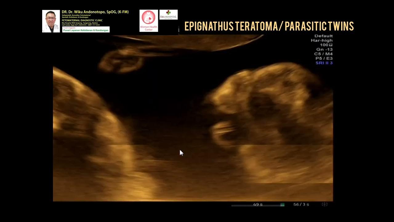 epignathus-teratoma-fetus-in-fetu-parasitic-twins-youtube