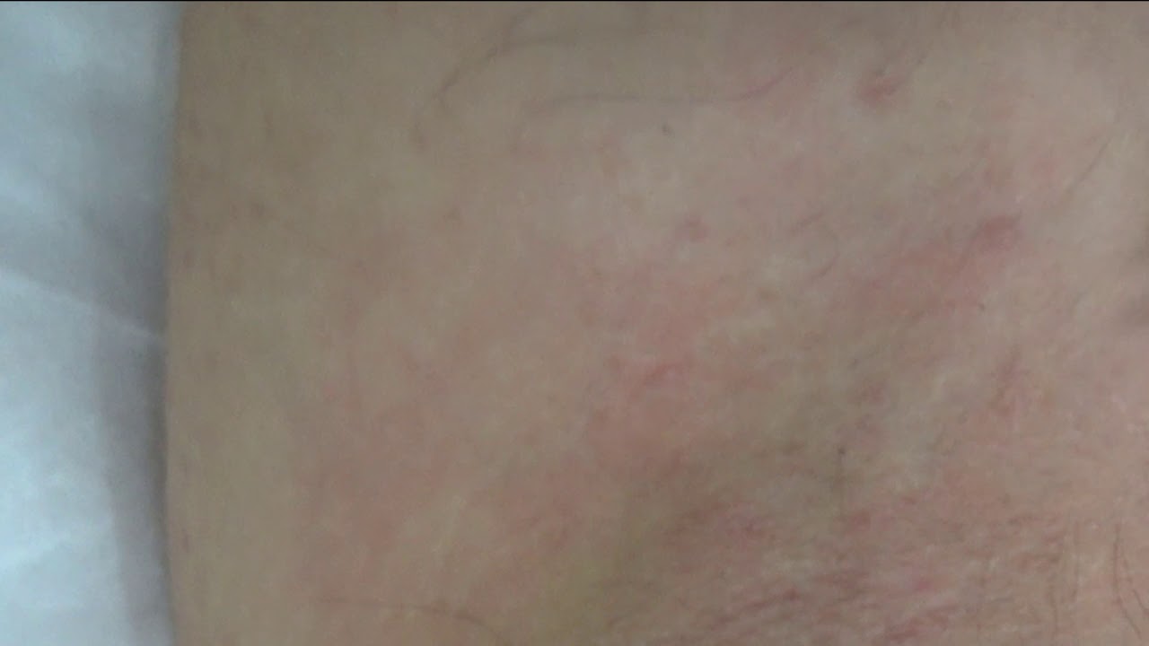Электроэпиляция подмышечных впадин, эпиляция подмышек онлайн - YouTube