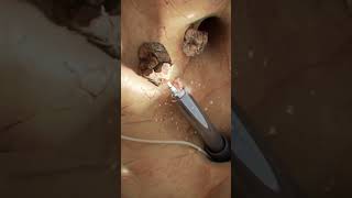FLEXIBLE ENDOSCOPIC LITHOTRIPSY | DR. TUNG KIDNEY STONES