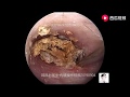 Treatment of external auditory canal cholesteatoma under general anesthesia for 12 minutes