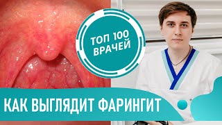 Как выглядит фарингит (фото). Симптомы фарингита. Острый и хронический фарингит у детей и взрослых