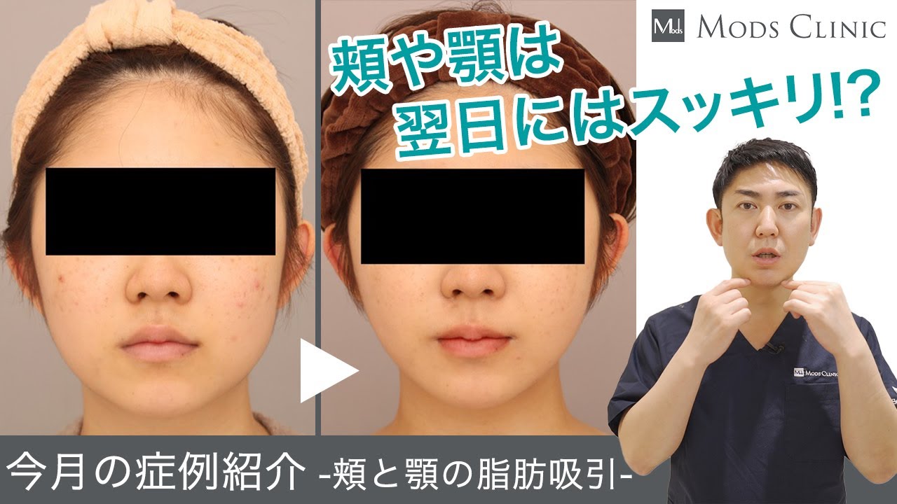 モッズ クリニック 脂肪 吸引