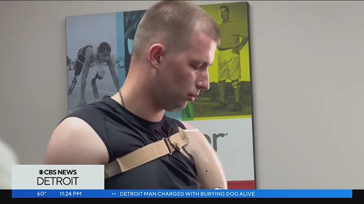 Ukraine soldier who lost arm on battlefield receives prosthetic arm in Livonia