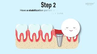 221229 ENG Dental implant treatment process that is useful if you know itVideo