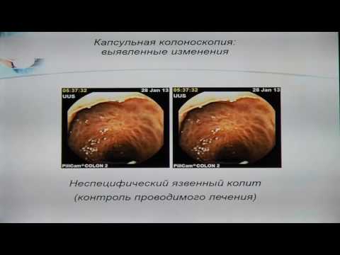 02 Домарев ЛВ Опыт использования капсульной колоноскопии