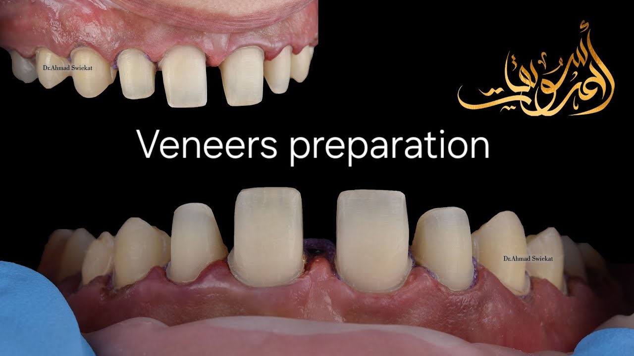 veneers preparation for anterior teeth ..how to ? YouTube