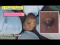 Face Cyst Removal. Live. DR Khaled Sadek