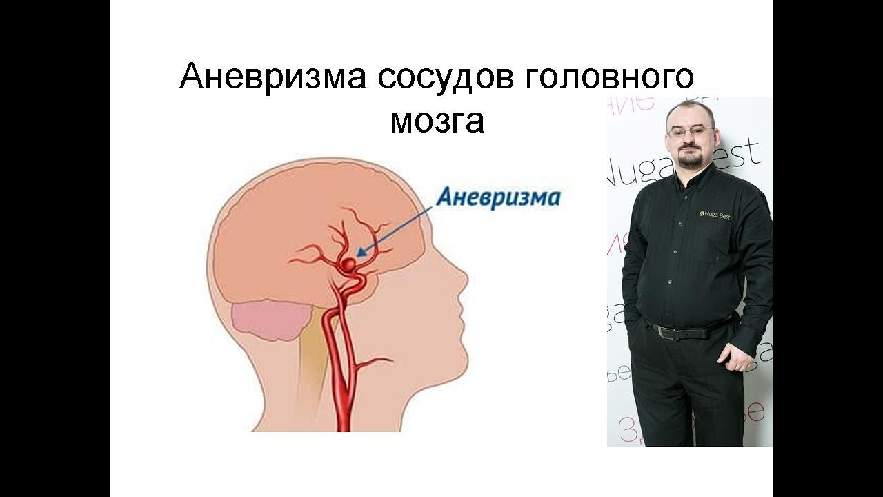 Аневризма сосудов головного мозга – её проявления, диагностика и ...