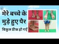 ११ साल के उम्र में क्लब फुट को प्लास्टर एवं छोटे ऑपरेशन से पूरी तरह से ढीक हो गया