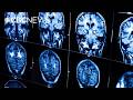 New guidelines urge doctors to treat heart and brain health together