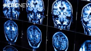 New guidelines urge doctors to treat heart and brain health together