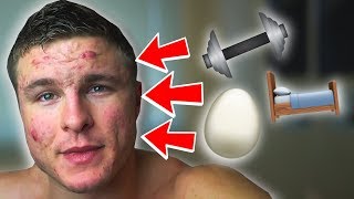 Does THIS Cause Acne? | Working Out, Eggs & More (EP. 4)