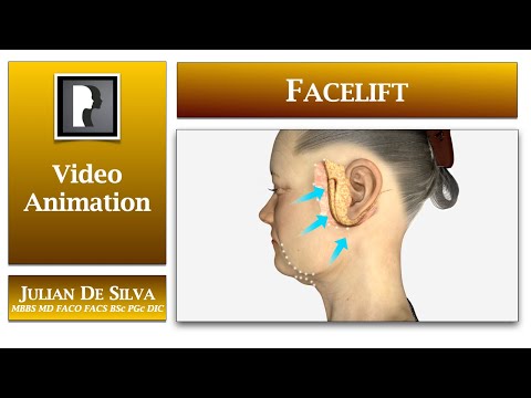 Facelift & Neck Lift Surgical Procedure: 3D medical animation by Dr Julian De Silva