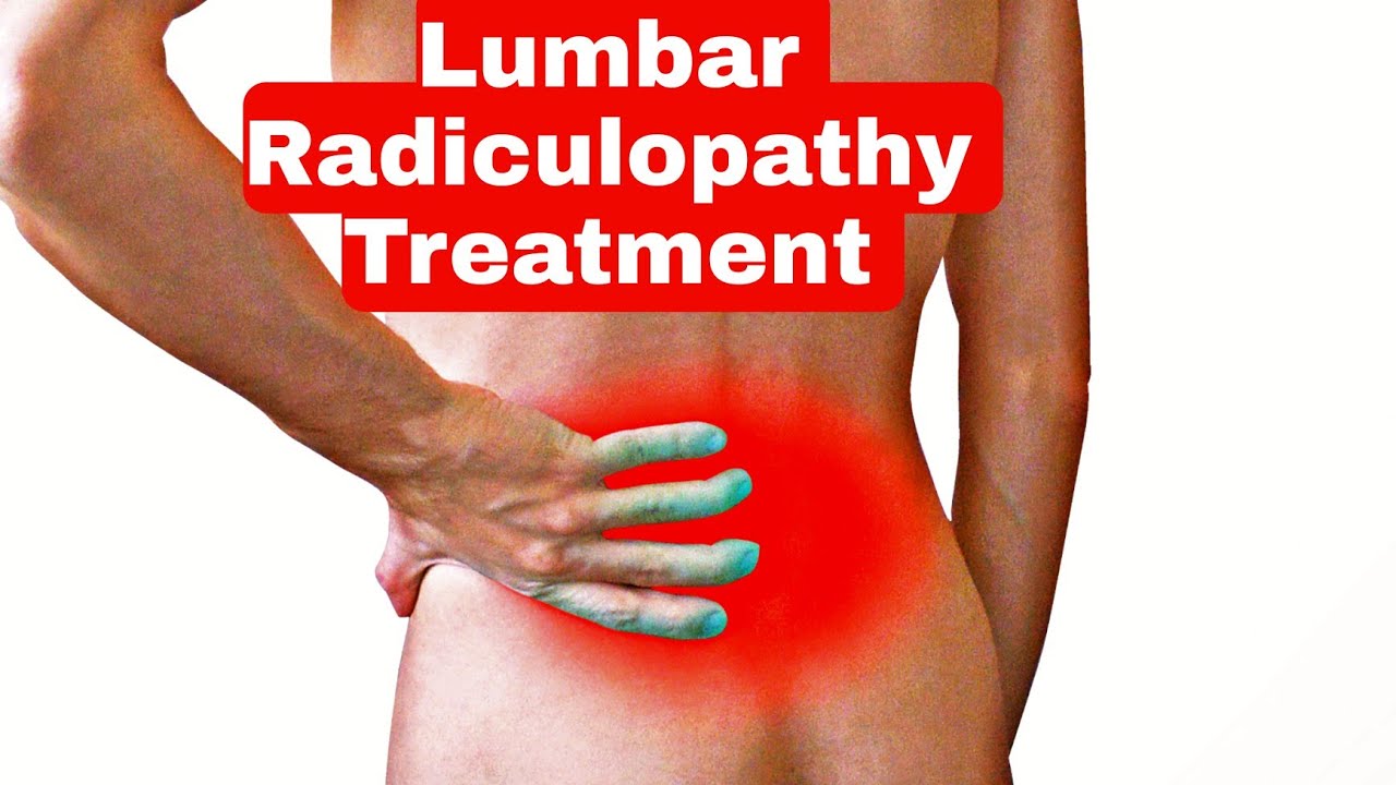 Best Treatment for Lumbar Radiculopathy Nerve pain Exercise for