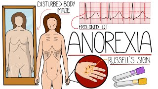 Understanding Anorexia (Anorexia Nervosa Explained Clearly)