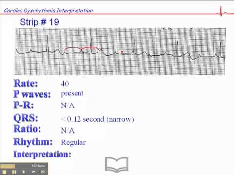 ECG: Exercise #19