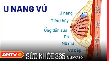 Chuyên gia nói về triệu chứng và cách điều trị bệnh u nang tuyến vú | Sức khỏe 365 | ANTV