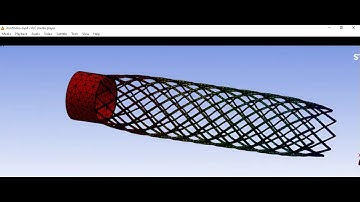 FEA Simulation of Cardiovascular Coronary Stent  BIOMATERIALS BY ANSYS Biomedical PLAGUE CHOLESTROL