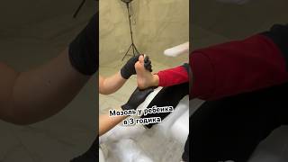 Маленький пациент | причина появления мозоли у детей #подологмосква #мозоли #удалениемозоли #подолог