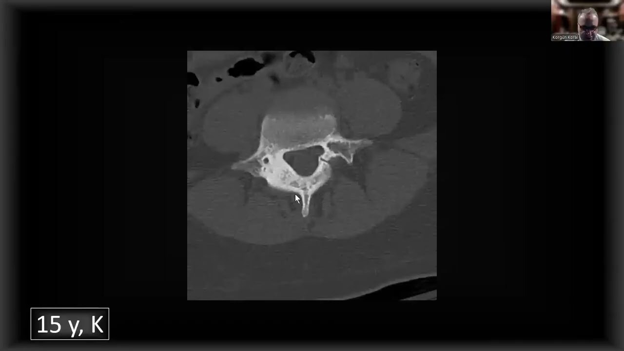 Pediatrik Sırt ve Bel Ağrısı