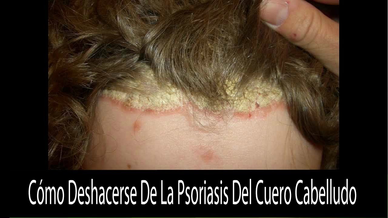 Cómo tratar la psoriasis del cuero cabelludo Cómo tratar la psoriasis del cuero cabelludo
