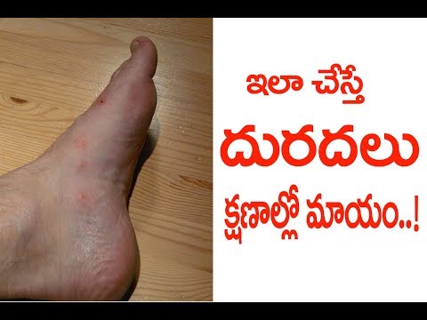 How To Get Rid Of Eczema, Psoriasis Itching At Home