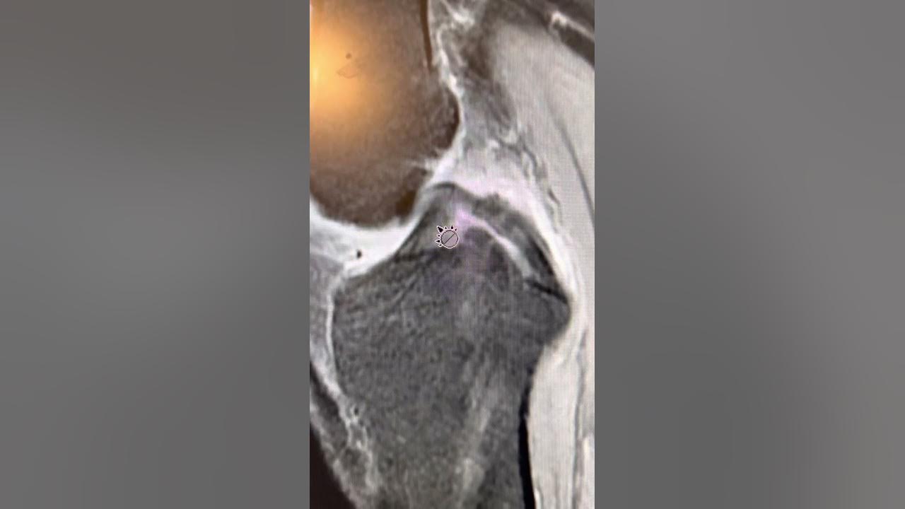 how-to-diagnose-a-medial-meniscus-root-tear-on-mri-youtube