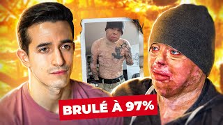 Brûlé à 97% : il racconte son terrible accident (le plus grand brûlé au monde)