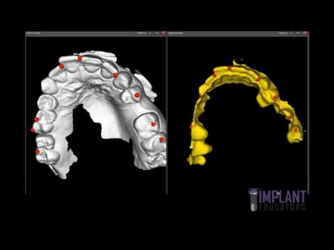 Aligning STL Models into occlusion without optical scanner