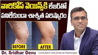 వారికోస్ వెయిన్స్ కి పరిష్కారం || Varicose Veins And Super Glue Therapy || Spider Veins || Dr Devu