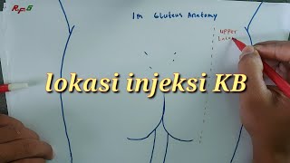 Lokasi Suntik KB di Bokong | intramuscular injection