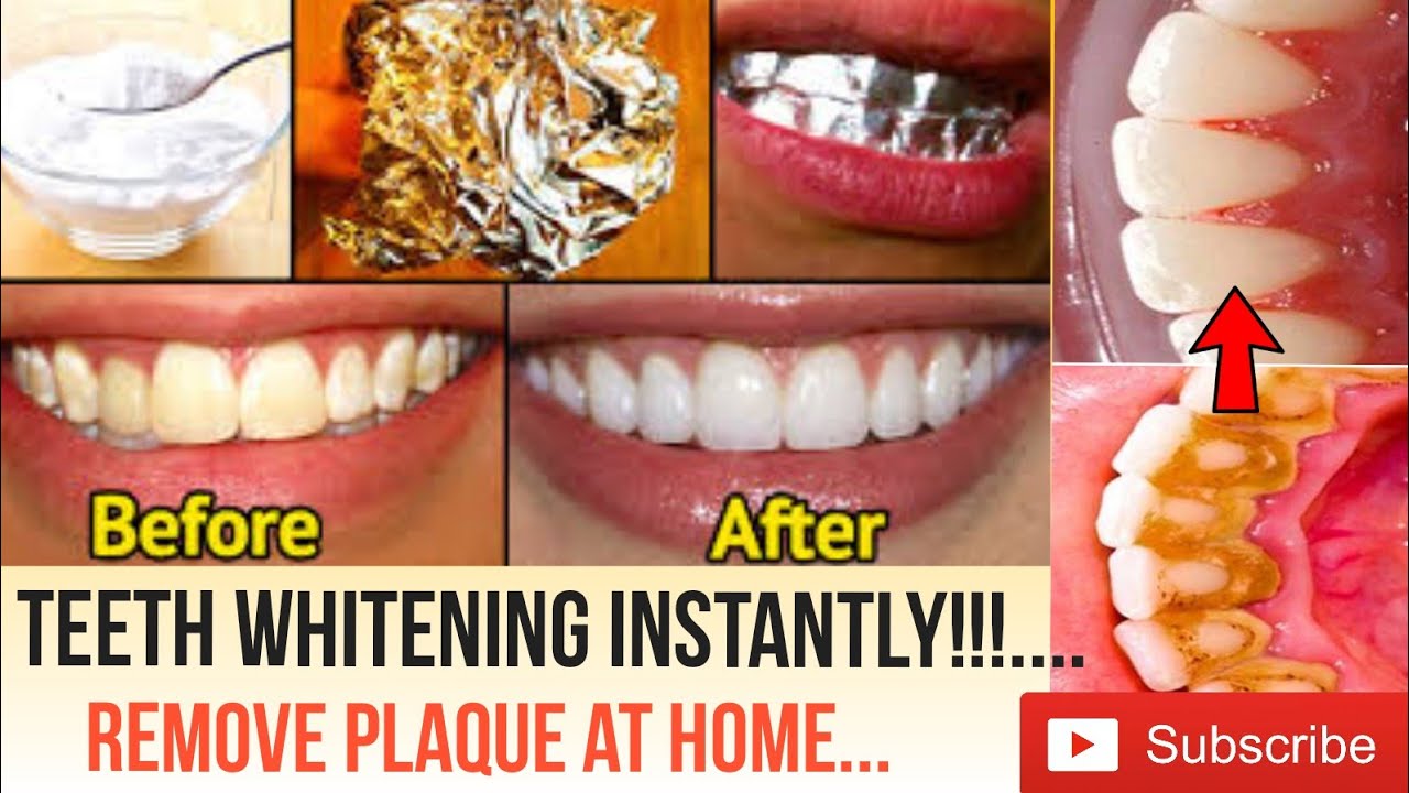TEETH WHITENING INSTANTLY Remove Plaque and Tartar TEETH WHITENING