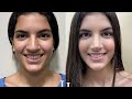 Rinoplastia Dr Jaimes 15/08/24