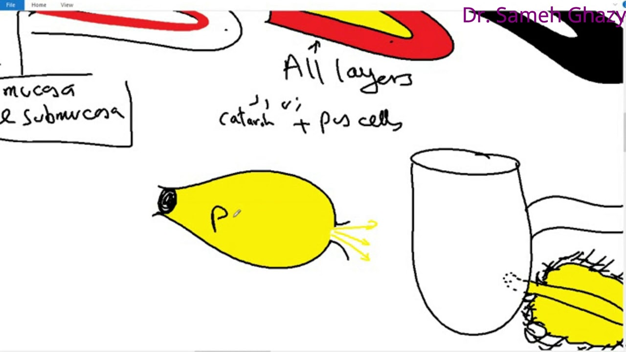 Systemic pathology 38 : GIT 8 (appendicitis , intestinal obstruction , malabsorption syndrome )
