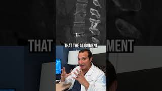 Adjacent Segment Disease After Spinal Fusion