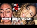 WATCH THIS BEFORE GOING ON OR IF ON ACCUTANE