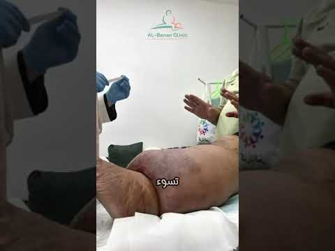 داء الفيل او التفيل انسداد الاوعية اللمفاوية عيادة البنان اكسبلور دايت  تيك توك