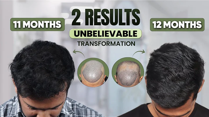 Hair Transplant in Kochi  (HX-BZGF) | Best Results & Cost of Hair Transplant in Kochi