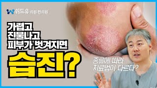 습진 치료법!! 습진 종류에 따라 치료법이 다르다?