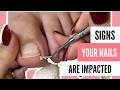 Foot Restoration: Fixing Thick Toenails, Calluses, and Athlete’s Foot | Meticulous Manicurist