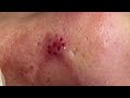 Popping huge blackheads and giant pimples  best pimple poppings 78