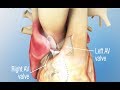 Atrioventricular (AV) Septal Defect Repair