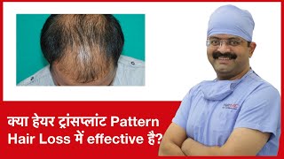 Is Hair Transplant Permanent Solution For Baldness? | HairMD, Pune | (In HINDI)